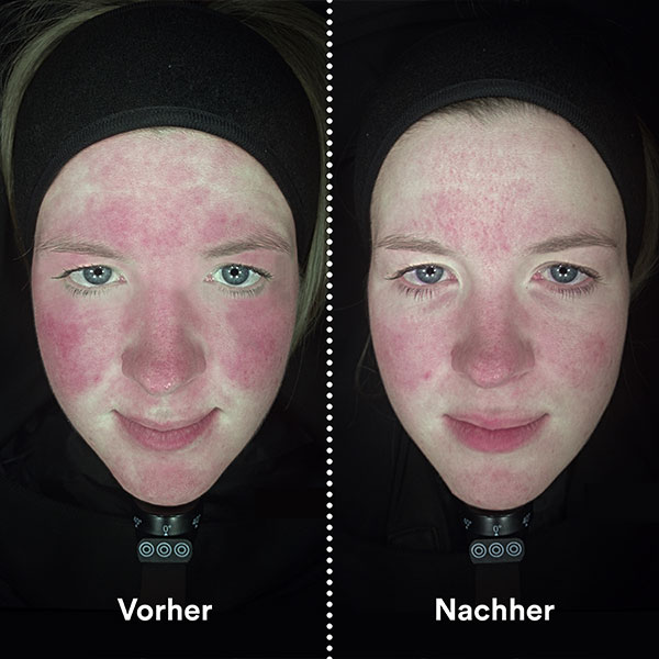Vorher / Nachher Vorher / Nachher Bild Hautanalyse bei Emilia Timeless Elegance